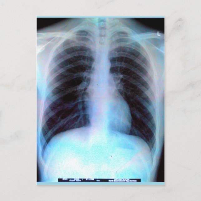 Ribcage Xray Skeleton Postcard (Front)