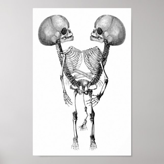 Siamese conjoined Twins Anatomy Skeletons art Poster (Front)