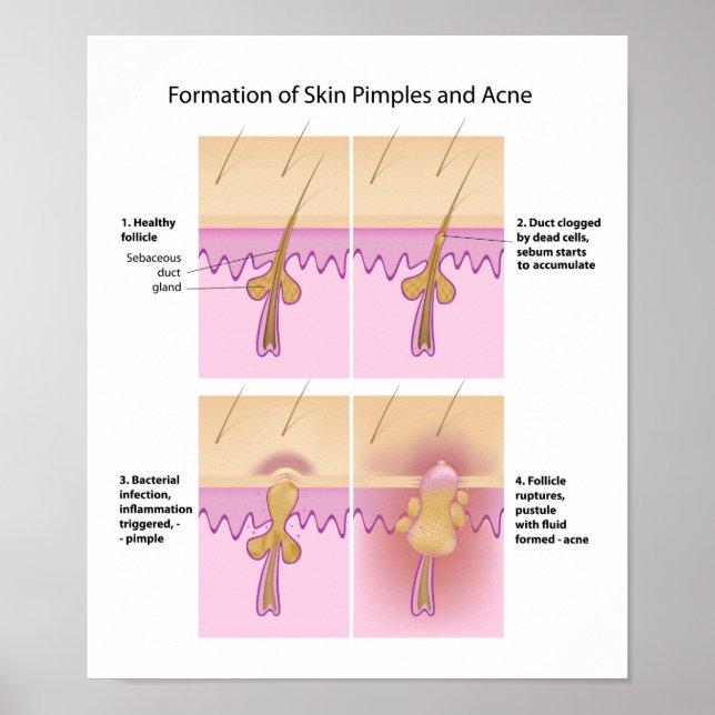 Skin Acne and pimples Poster (Front)