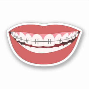 Smile Orthodontic Appliance