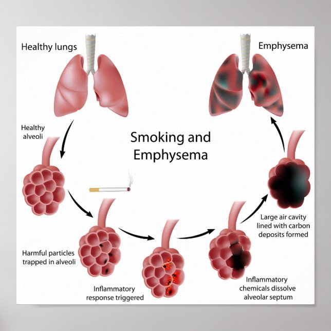 Smoking and emphysema  Poster (Front)