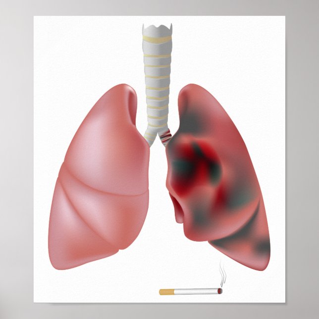 Smoking and lung cancer Poster (Front)