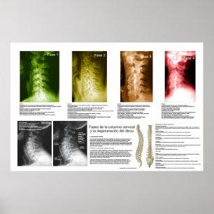 Spanish Phases Cervical Spinal Degeneration Poster