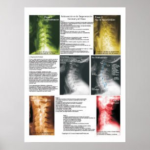 Spanish Subluxation Cervical Spinal Degeneration Poster