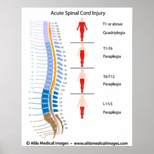 Spinal cord injury levels, labelled diagram. poster