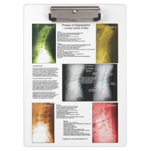 Spinal Degeneration Chiropractic Clipboard