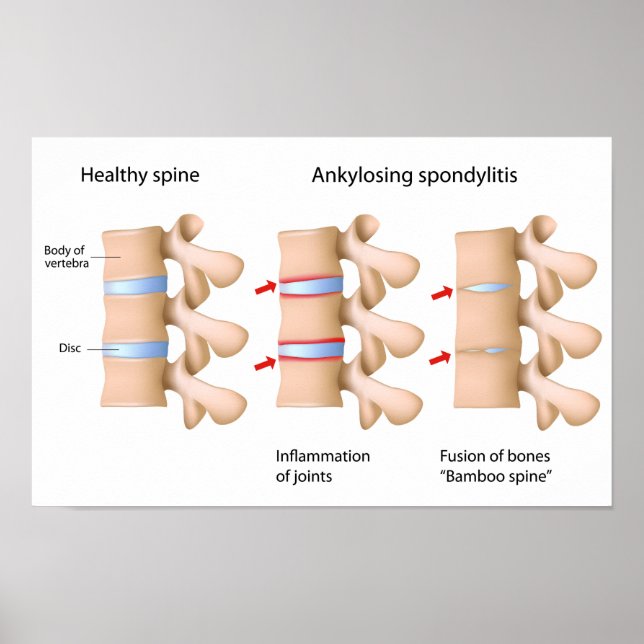 Spine Ankylosing spondylitis Poster (Front)