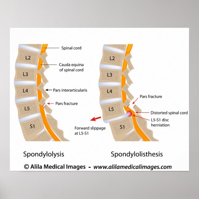 Spondylolysis and spondylolisthesis, labelled poster (Front)