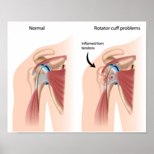 Sport injury shoulder impingement Poster
