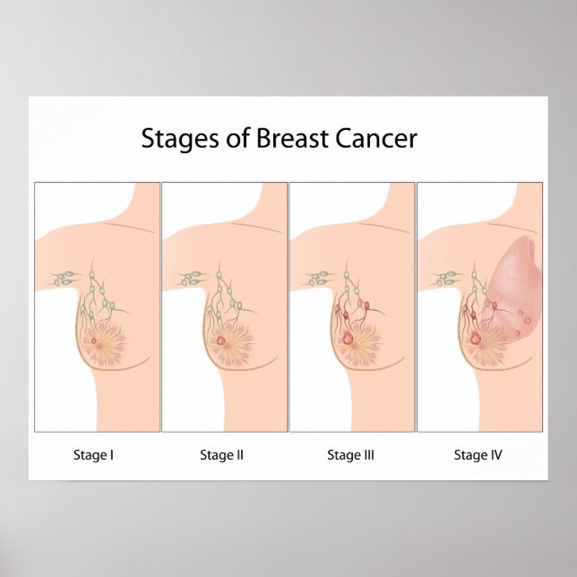 Stages of Breast Cancer Poster (Front)