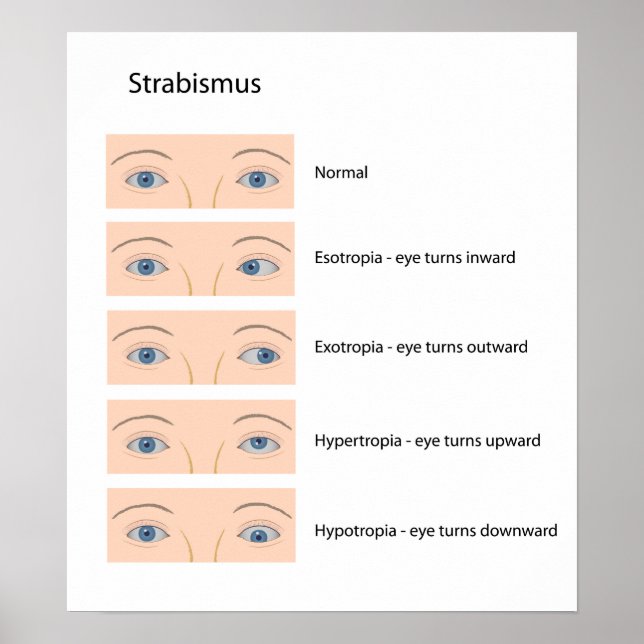Strabismus eye defect Poster (Front)