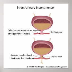 Stress urinary incontinence in women. poster