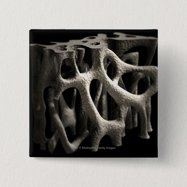 Structure of a bone with osteoporosis 15 cm square badge (Front)
