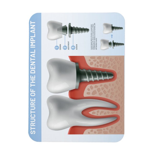 Structure of the Dental implant Magnet (Vertical)