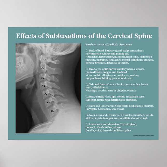 Subluxation Effects Spine Poster Chiropractic (Front)
