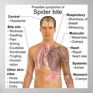 Symptoms Common in Poisonous Spider Bites Chart