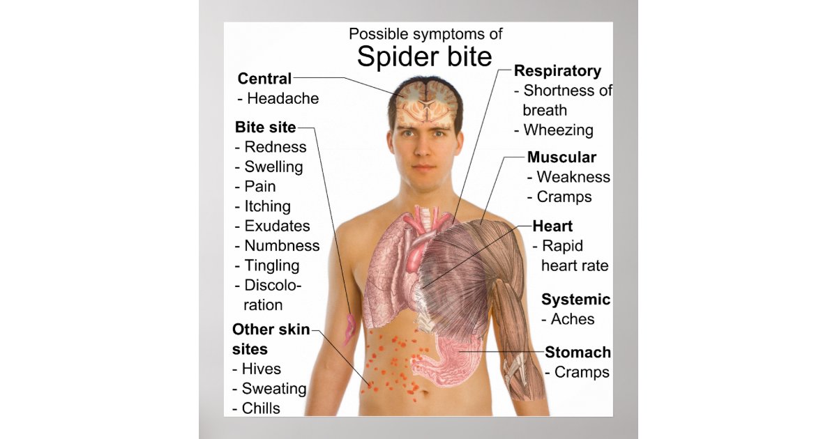Symptoms Common in Poisonous Spider Bites Chart | Zazzle ...