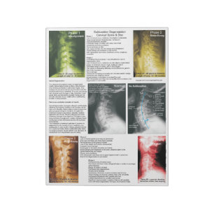 Tear Off Pad Subluxation Cervical Degeneration