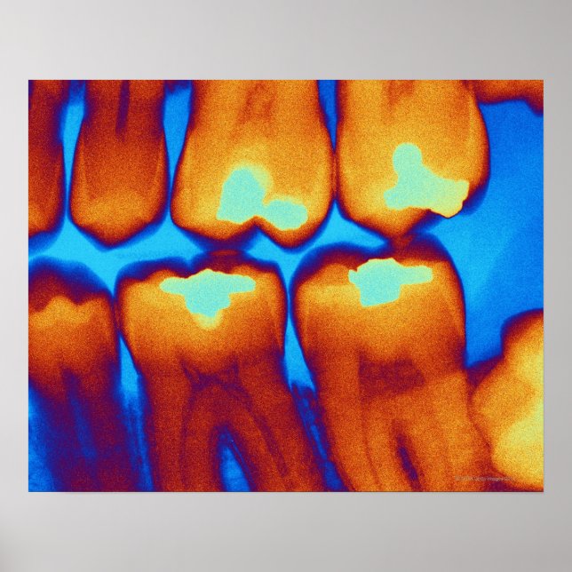 Teeth with fillings (green), coloured X-ray. Poster (Front)