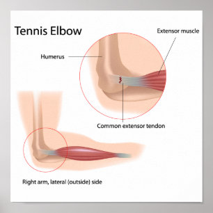 Tennis elbow Sport injury Poster