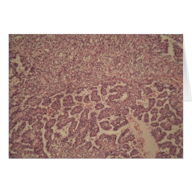 Thyroid gland cells with cancer (Front Horizontal)