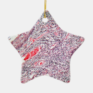 Tissue cells from a human cervix with cancer ceramic ornament