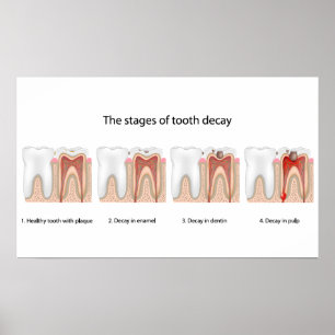 Tooth decay Poster