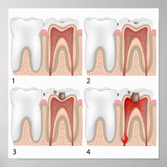 Tooth decay Poster (Front)