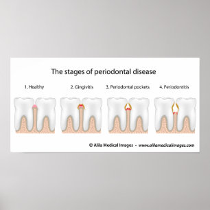 Tooth Periodontal Disease Poster