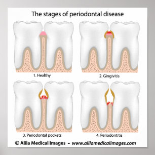 Tooth Periodontal Disease Poster