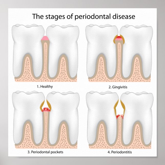 Tooth Periodontal Disease Poster (Front)