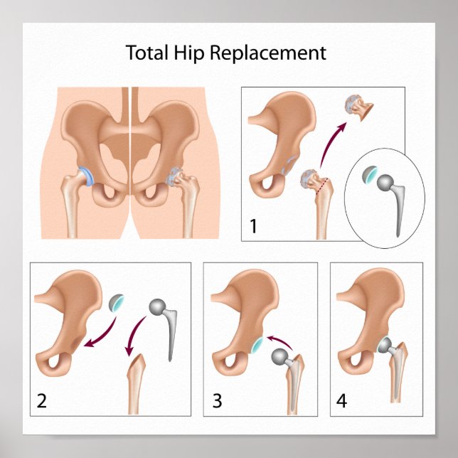 Total hip replacement surgery poster (Front)