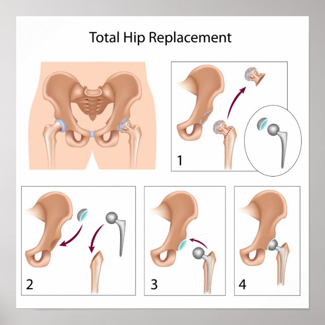 Total hip replacement surgery print (Front)