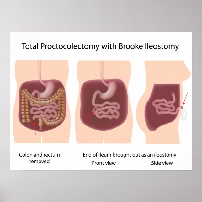 Total proctocolectomy with Brooke ileostomy poster (Front)
