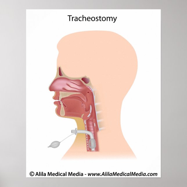 Tracheostomy drawing. poster (Front)