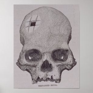 Trepanned Skull Poster