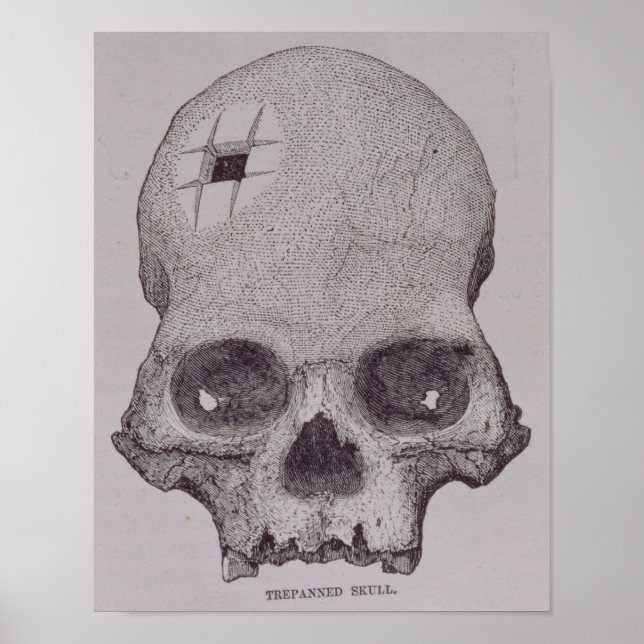Trepanned Skull Poster (Front)