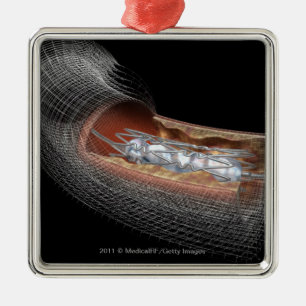 View of an angioplaty balloon in an artery metal ornament