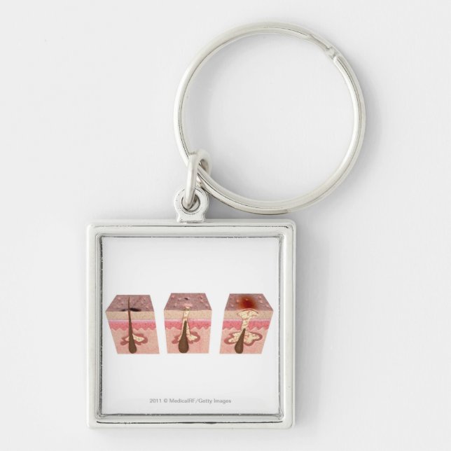View of what causes acne key ring (Front)