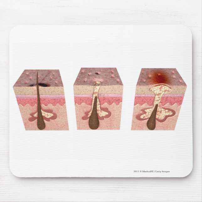 View of what causes acne mouse pad (Front)