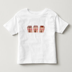 View of what causes acne toddler T-Shirt