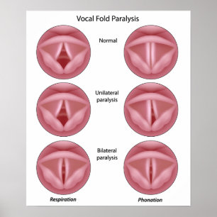 Vocal cord paralysis Poster