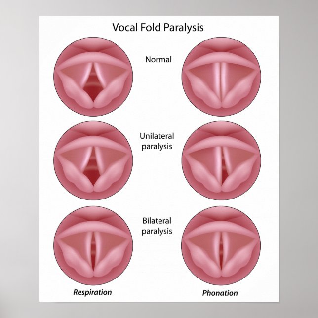 Vocal cord paralysis Poster (Front)