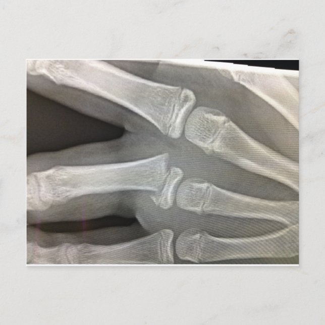 x-ray broken bone get well soon postcard (Front)