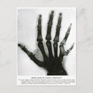 X-Ray Hand with Extra Finger Postcard