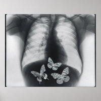 X-ray of butterflies in the stomach