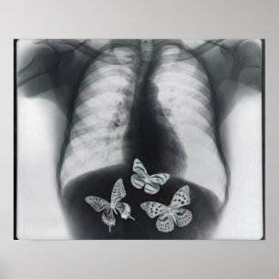 X-ray of butterflies in the stomach poster