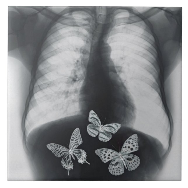 X-ray of butterflies in the stomach tile (Front)