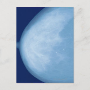 X-ray of female breast, side view postcard