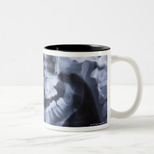 Xray of a girls jawline taken with a panoramic Two-Tone coffee mug